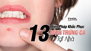 13 cách trị mụn trứng cá tại nhà đơn giản và an toàn - THOL