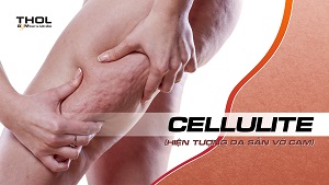 Tình trạng Cellulite - Sần da cam và cách phòng trị - THOL